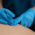 Acupuncture is a great way to treat your body